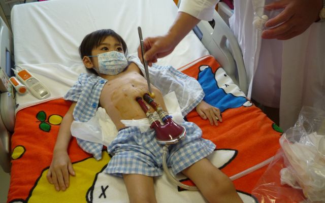 子ども用の補助人工心臓の管（カニューレ）が、体の外の血液ポンプとつながっています＝父・慎也さん提供